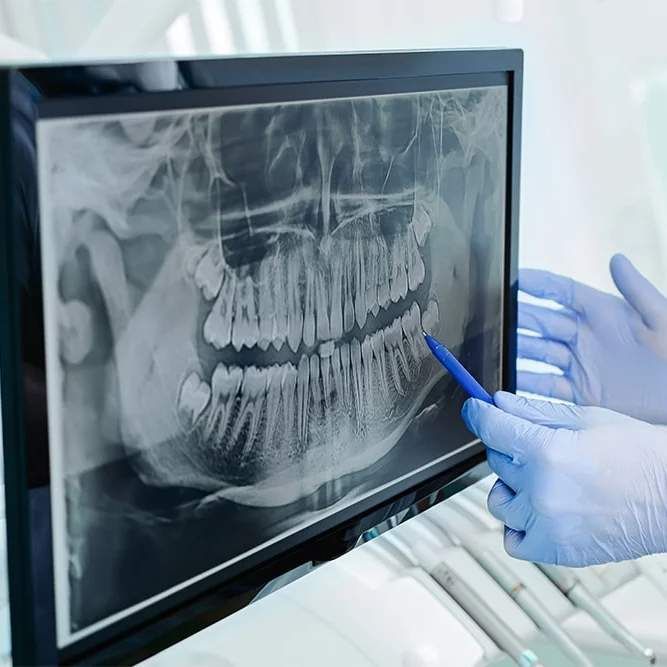 Dental X-ray on screen; gloved hand pointing with pen at teeth, presumably in a dentist's office.