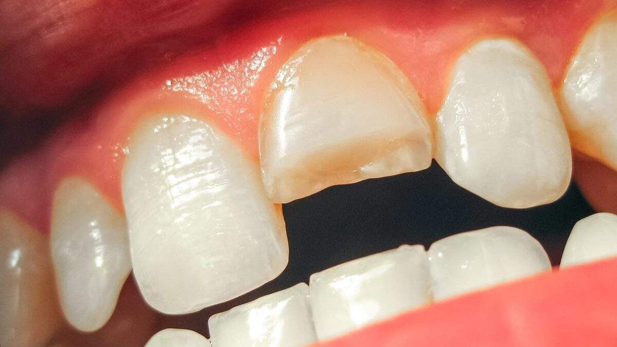 Close-up of a mouth showing a chipped front tooth with discoloration. Other teeth are healthy and white.