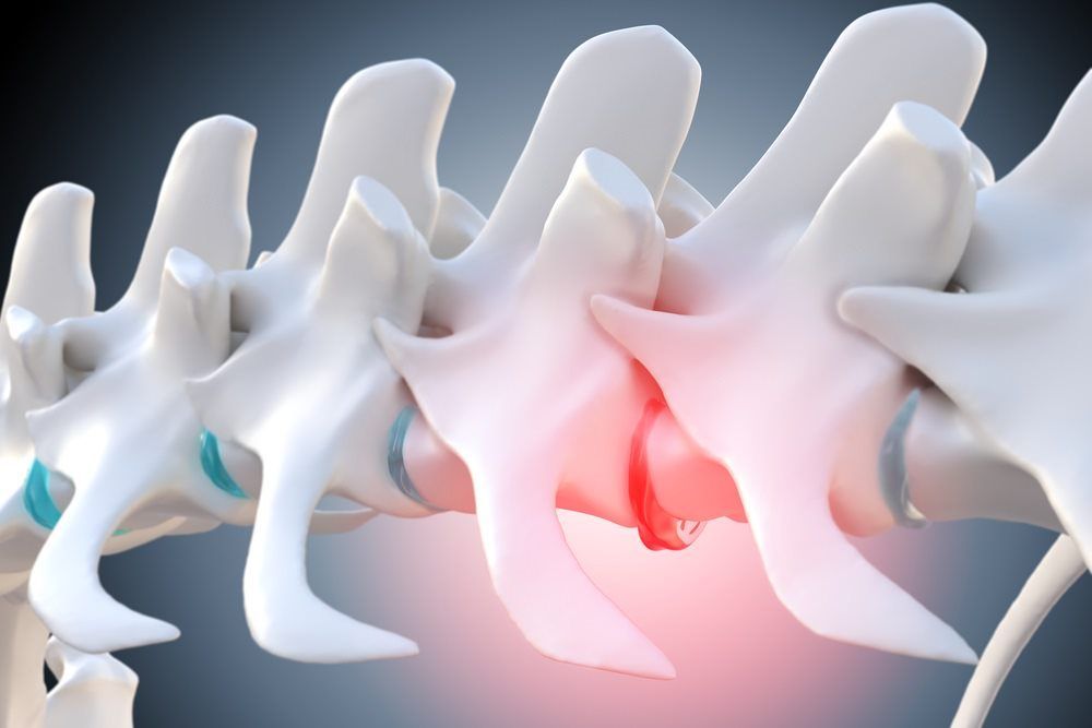 3d Illustration of a degenerated, prolapsed intervertebral disc of the dog spine — Marlin Coast Veterinary Hospital in Trinity Beach, QLD