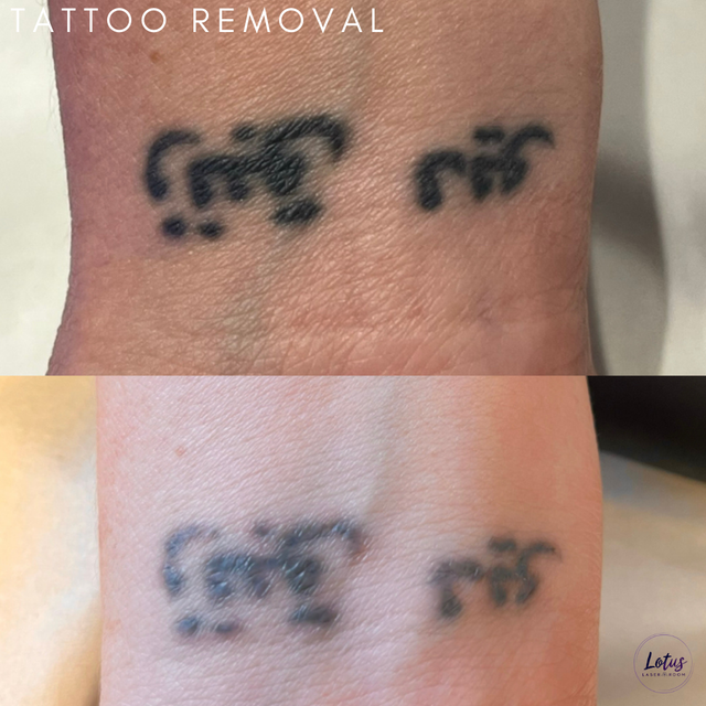Laser Hair Removal