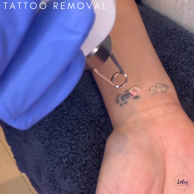 Laser Hair Removal