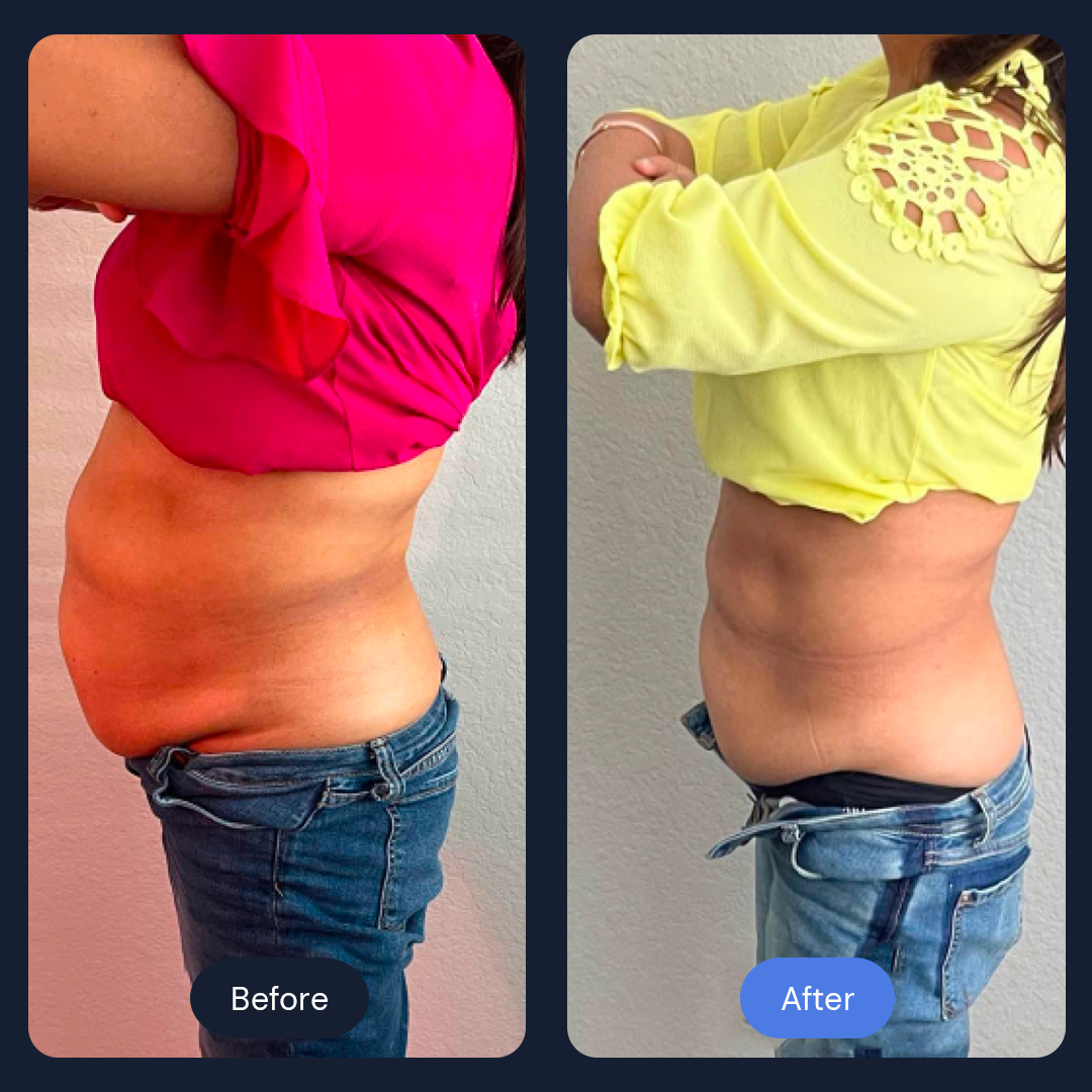 Side-by-side comparison of a person's abdomen, showing a reduction in belly fat after a treatment.