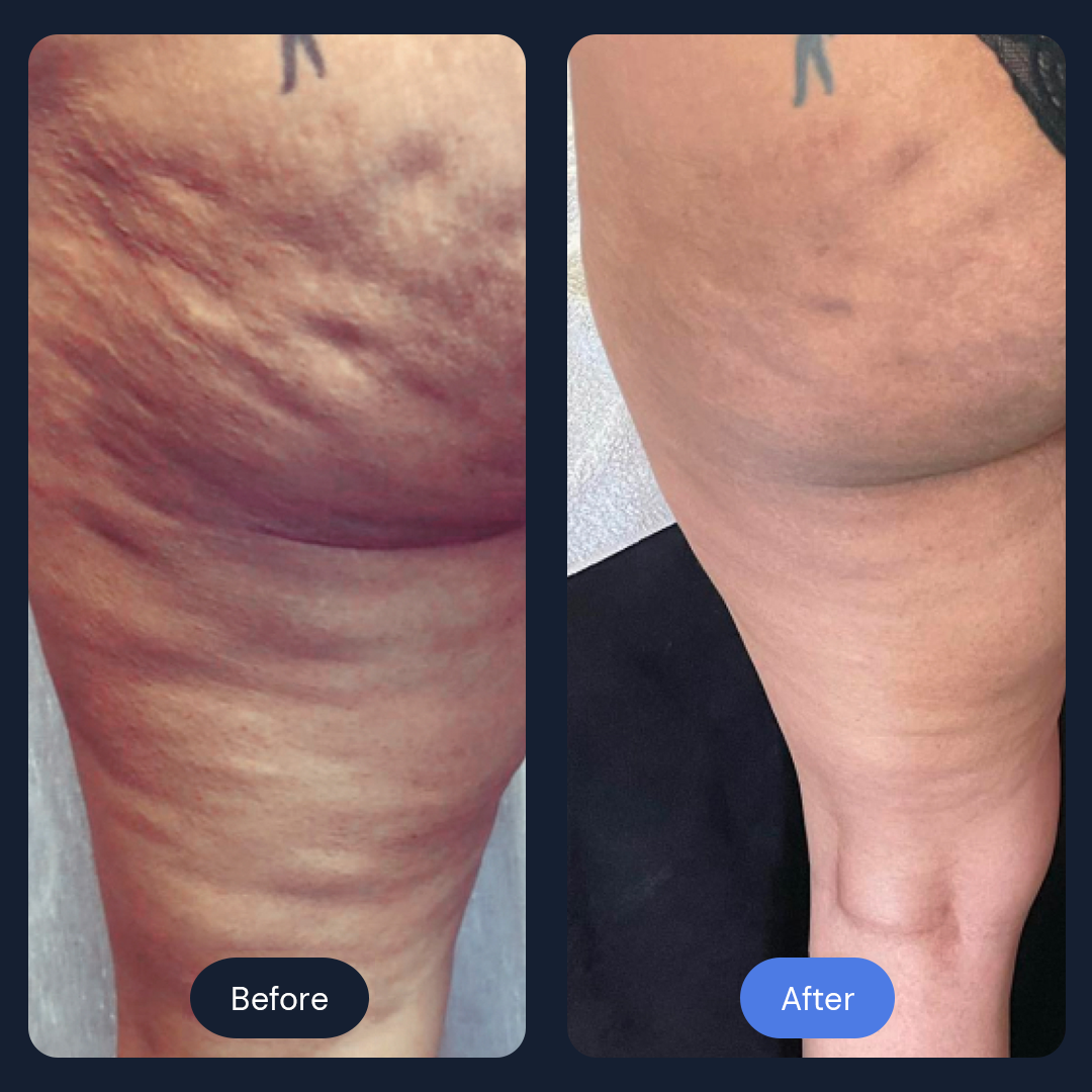 Comparison of a leg before and after treatment, reducing skin texture and cellulite.