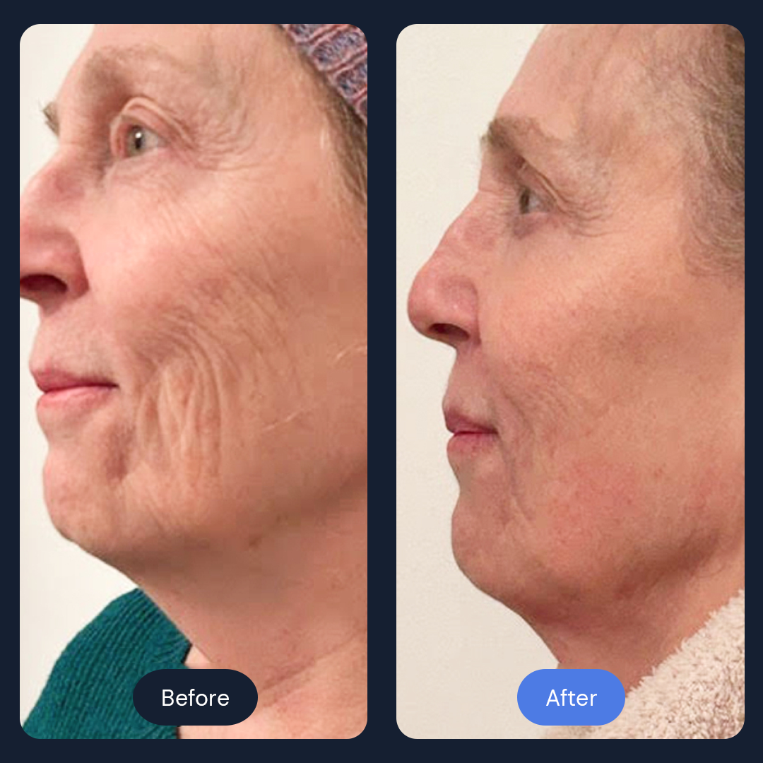 Side-by-side comparison shows a woman's face before and after a cosmetic procedure, reducing wrinkles.