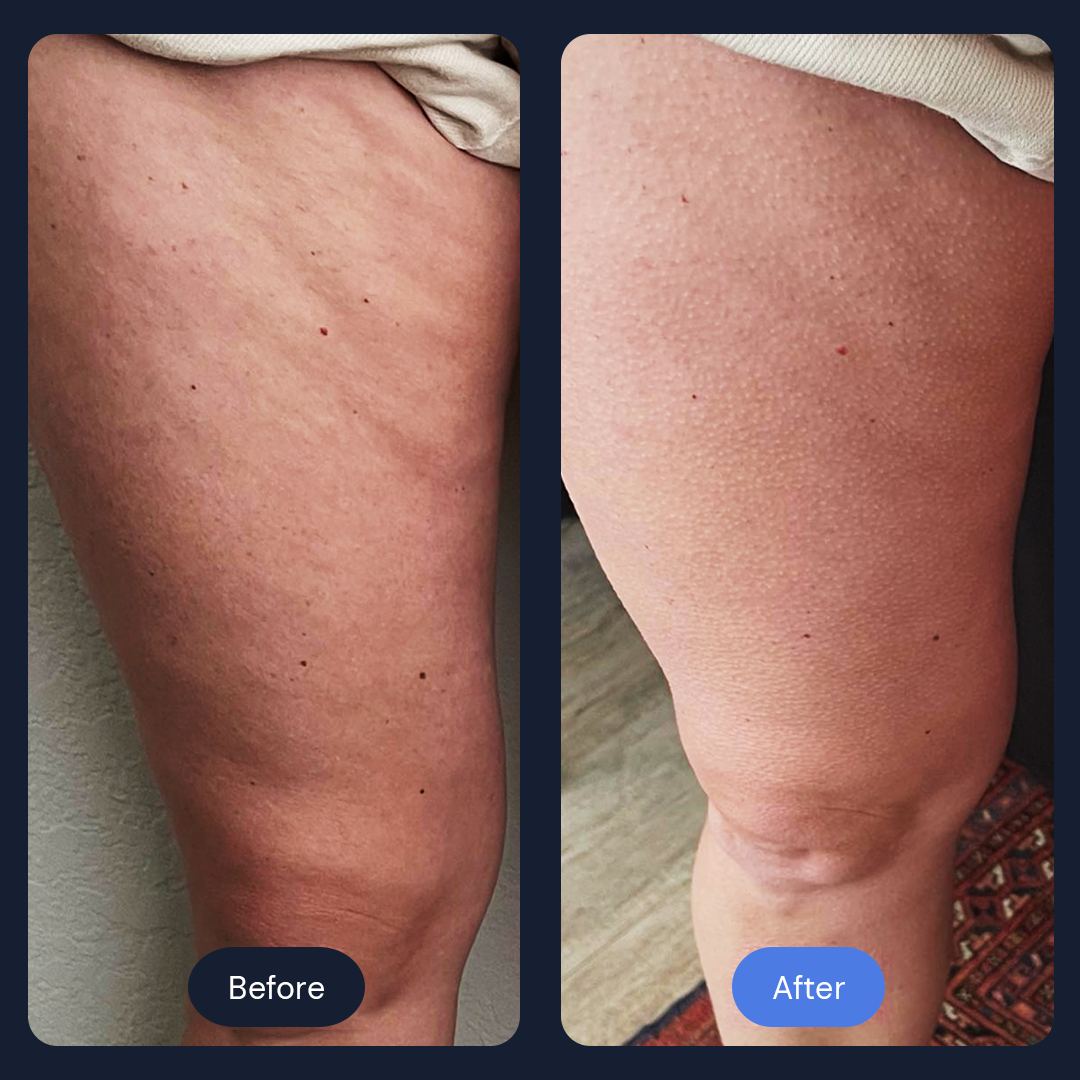 Comparison of a leg before and after a treatment, with visible stretch marks reduced.