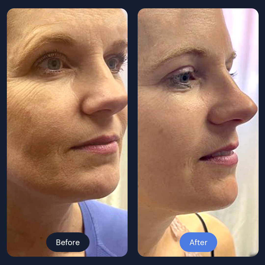 Before and after shots of a woman's face. The 