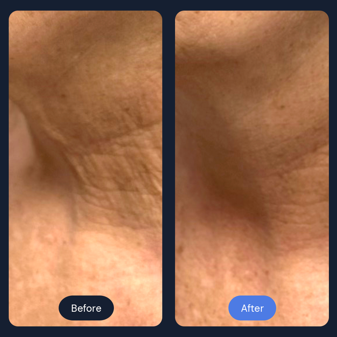 Neck skin comparison: before (wrinkled) and after (smoother) treatment.
