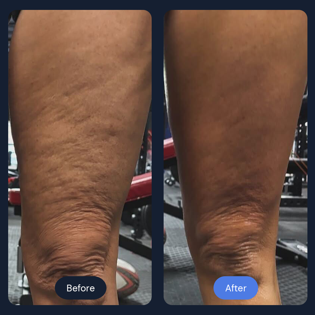 Comparison of a person's thighs before and after a treatment, showing a reduction in the appearance of cellulite.