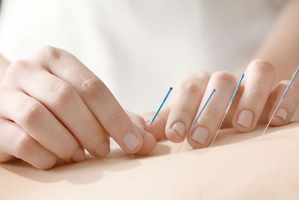 trattamento di agopuntura