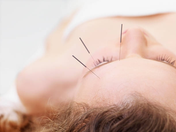 A woman receiving acupuncture treatment on her face.