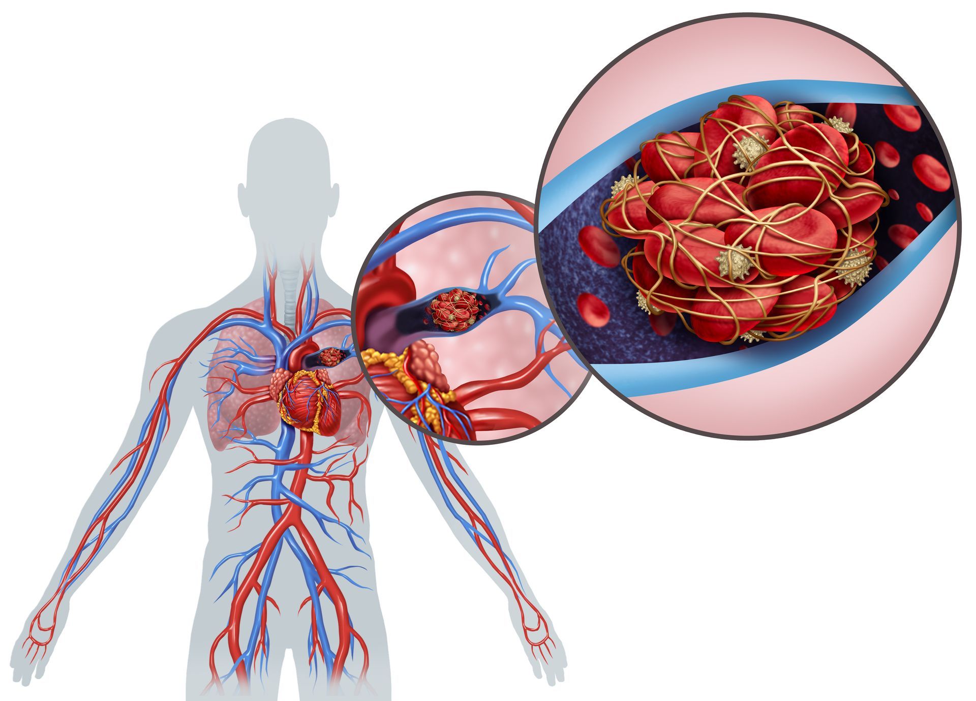 Pulmonary Embolism (PE)