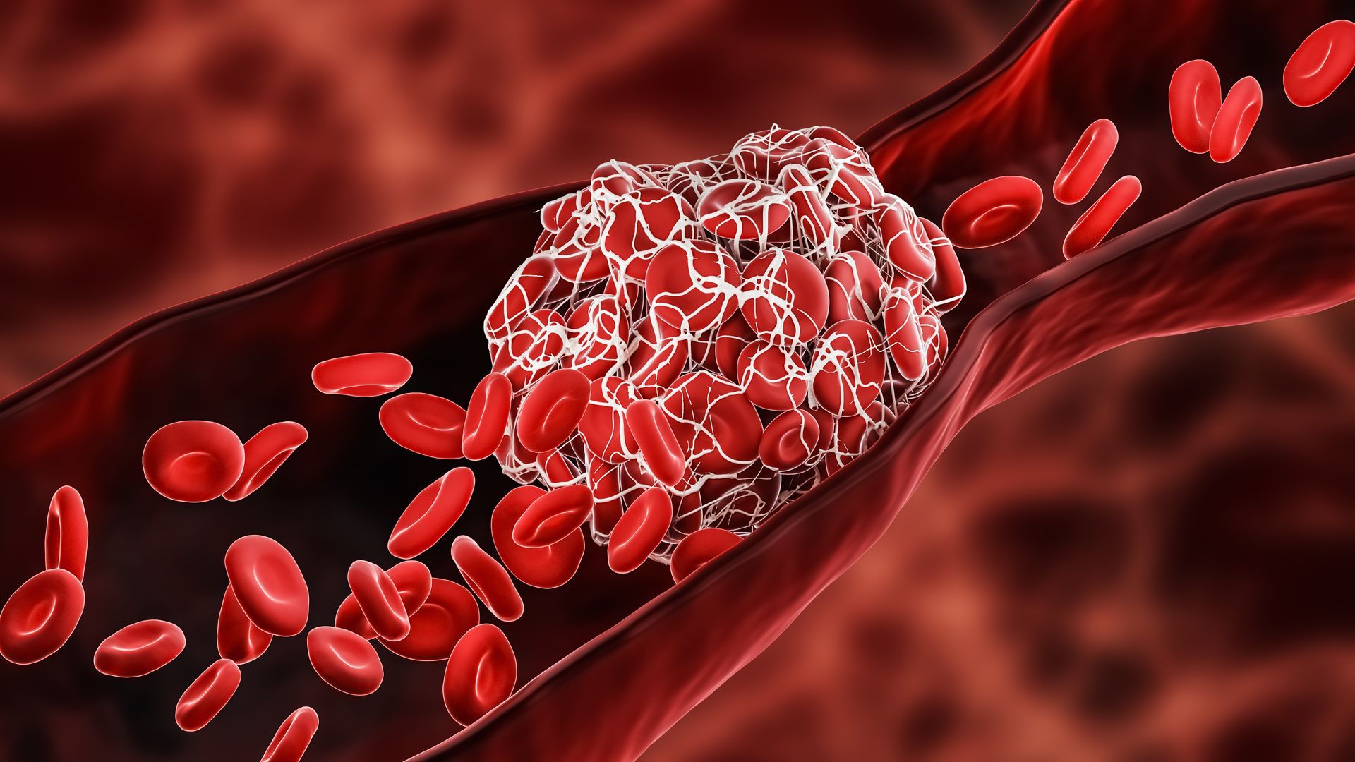 Deep Vein Thrombosis (DVT)