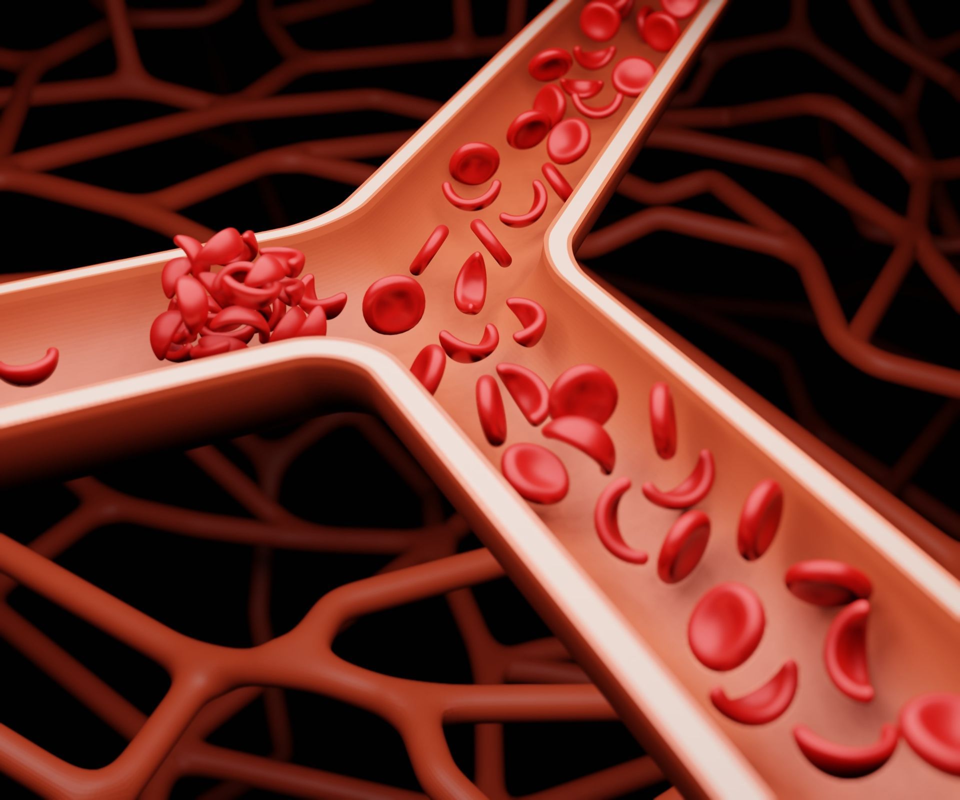 sickle cell