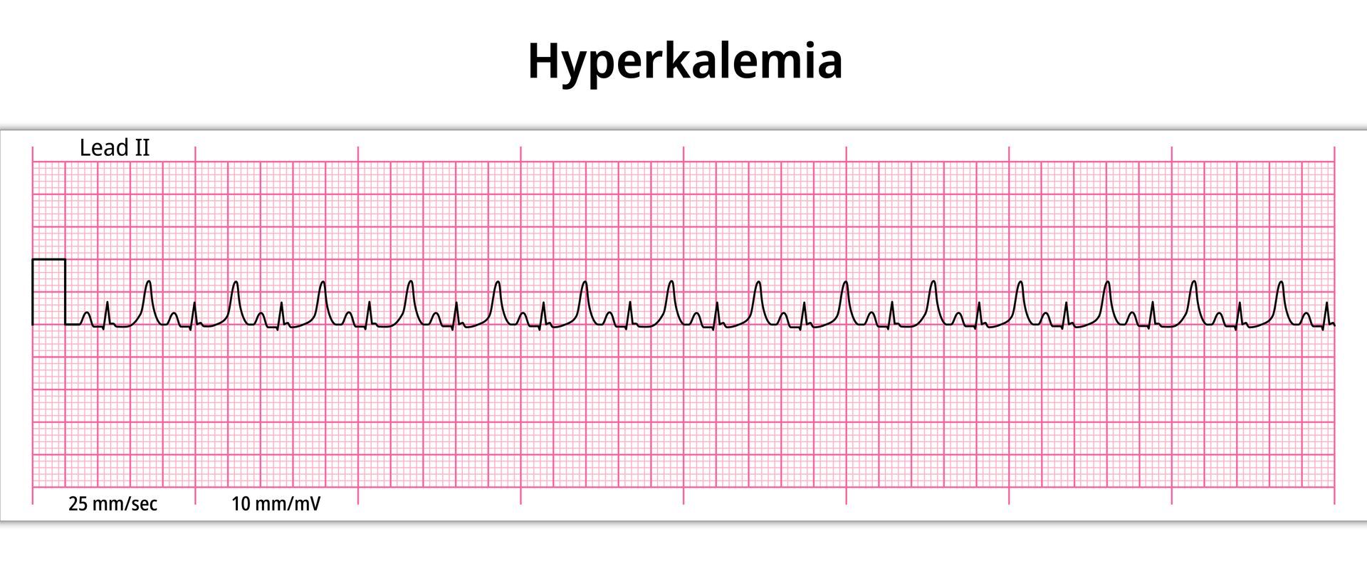 Hyperkalemia