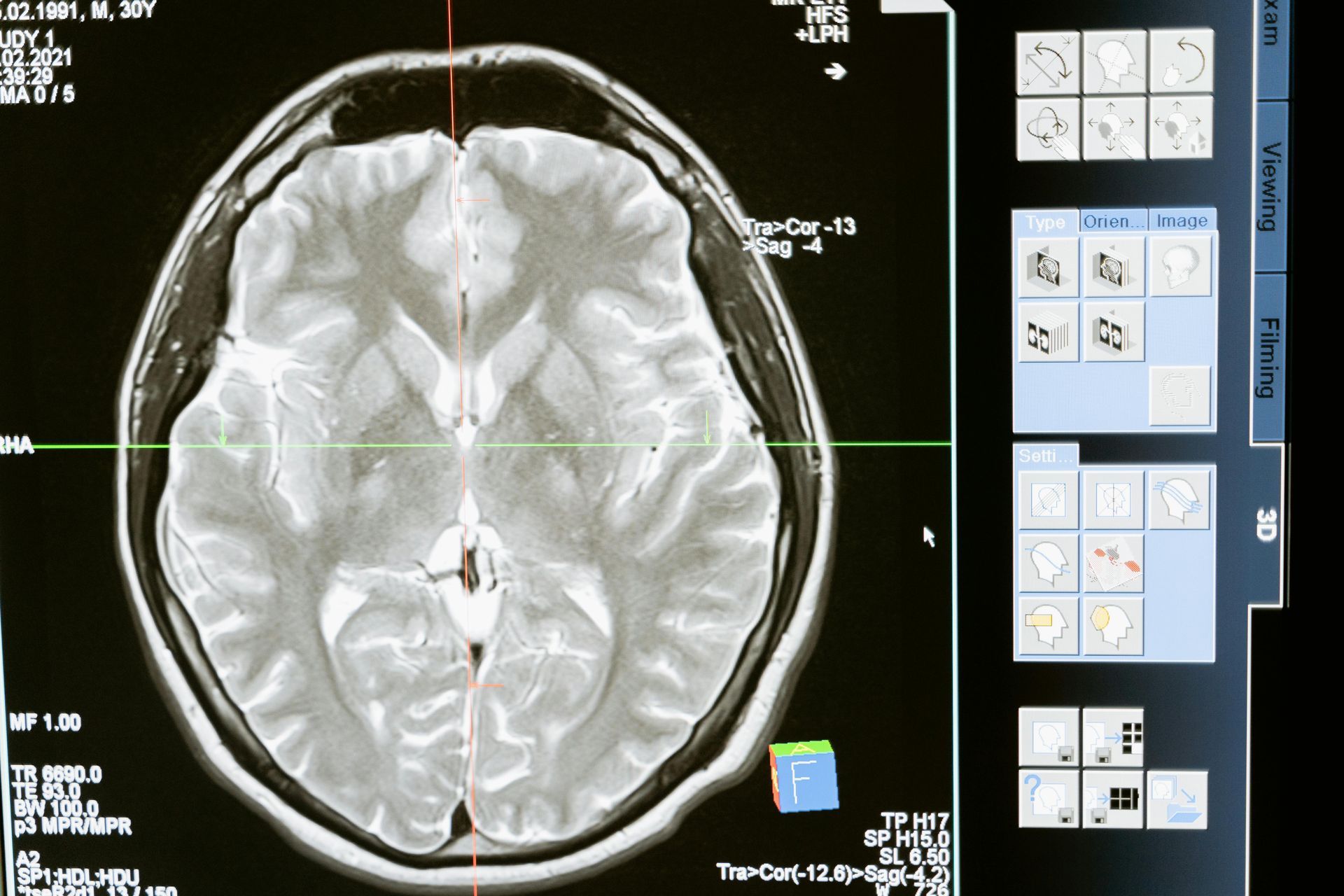 A computer screen shows a mri of a human brain