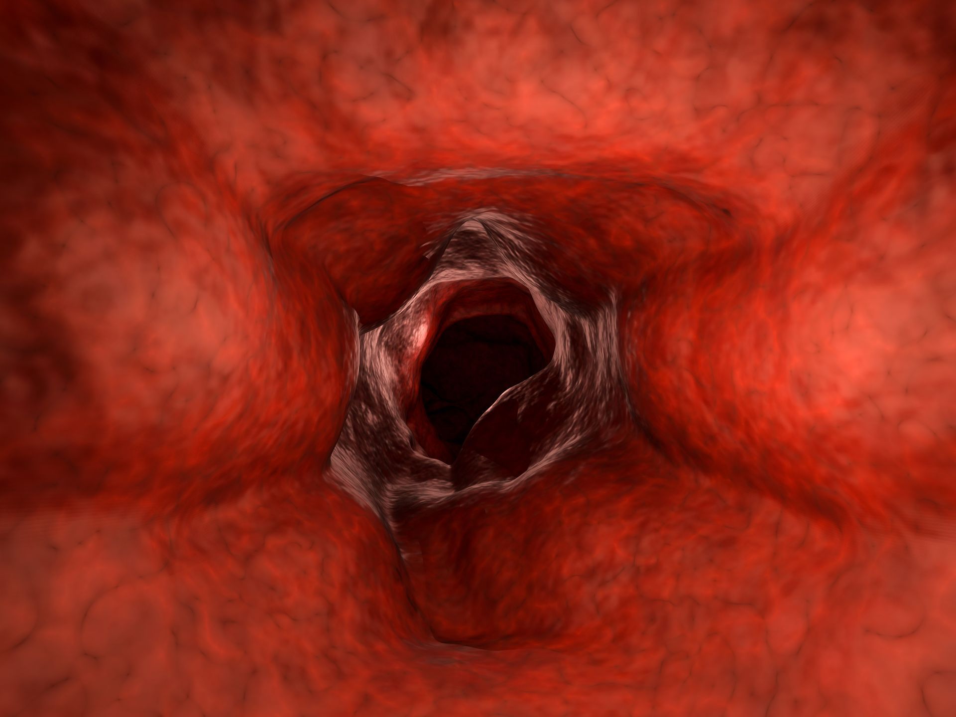 Gastrointestinal Bleed