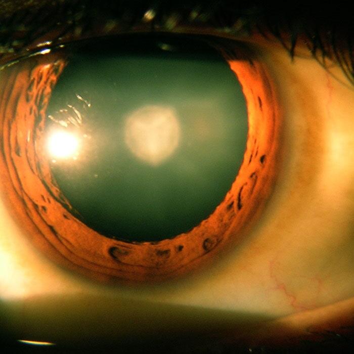 DR. ROBERTO LEAL LEYVA - Desprendimiento de retina