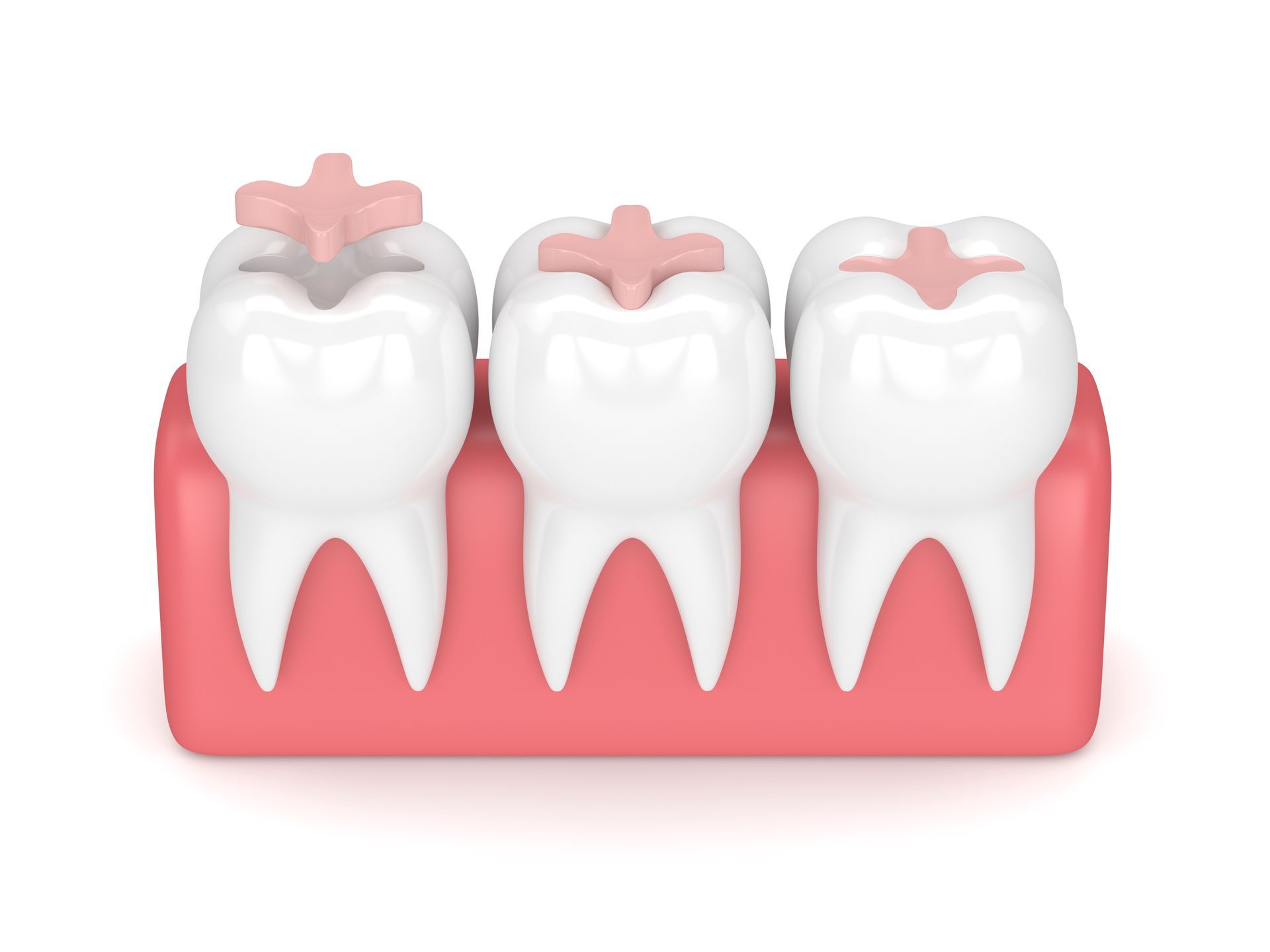 A 3d rendering of a group of teeth with fillings in them.