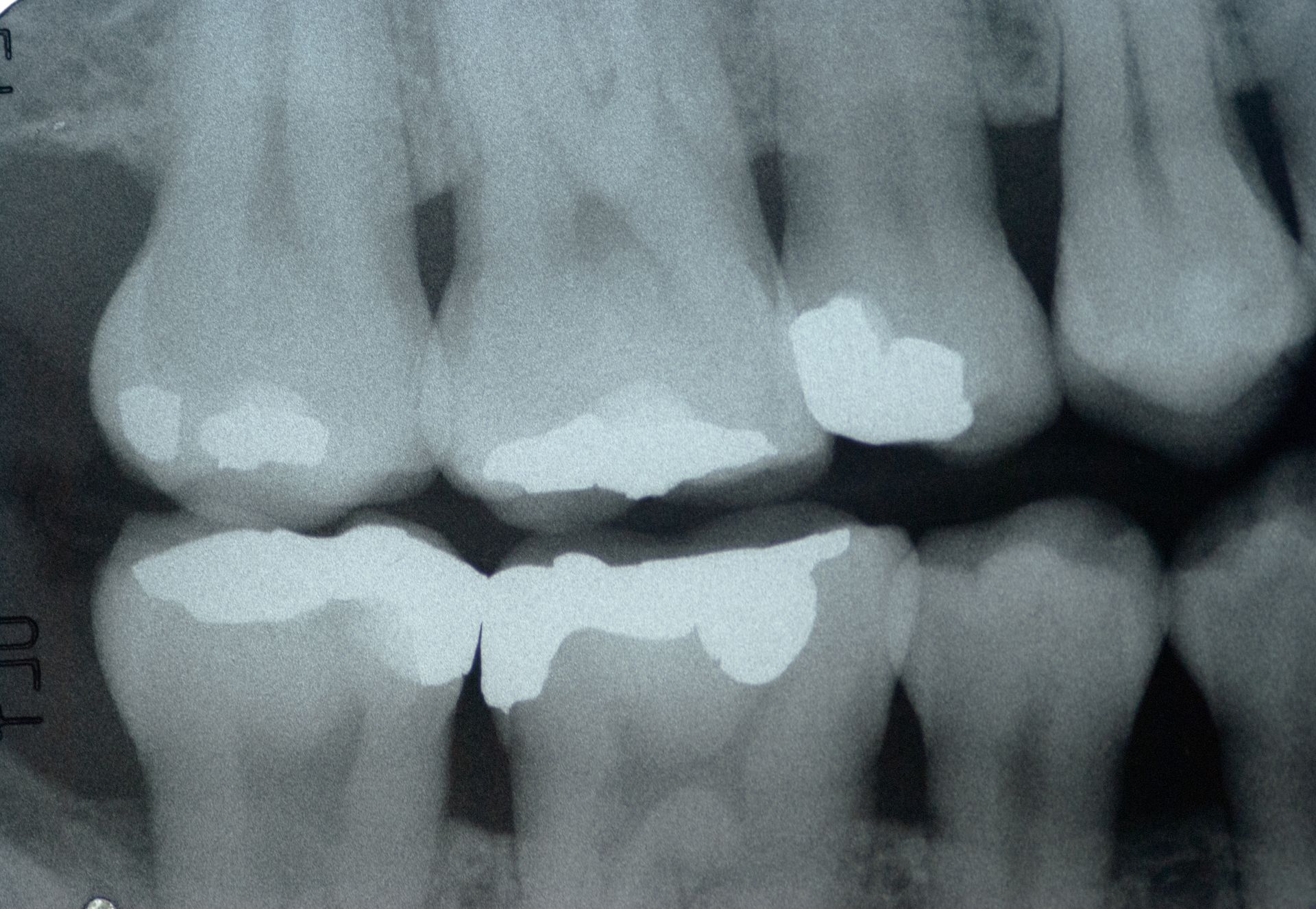 An x-ray of a person 's teeth showing a broken tooth.