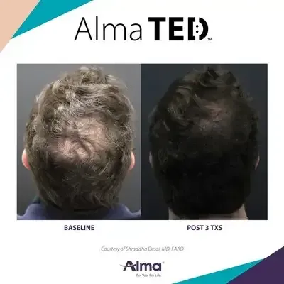 A before and after picture of a man 's hair growth.