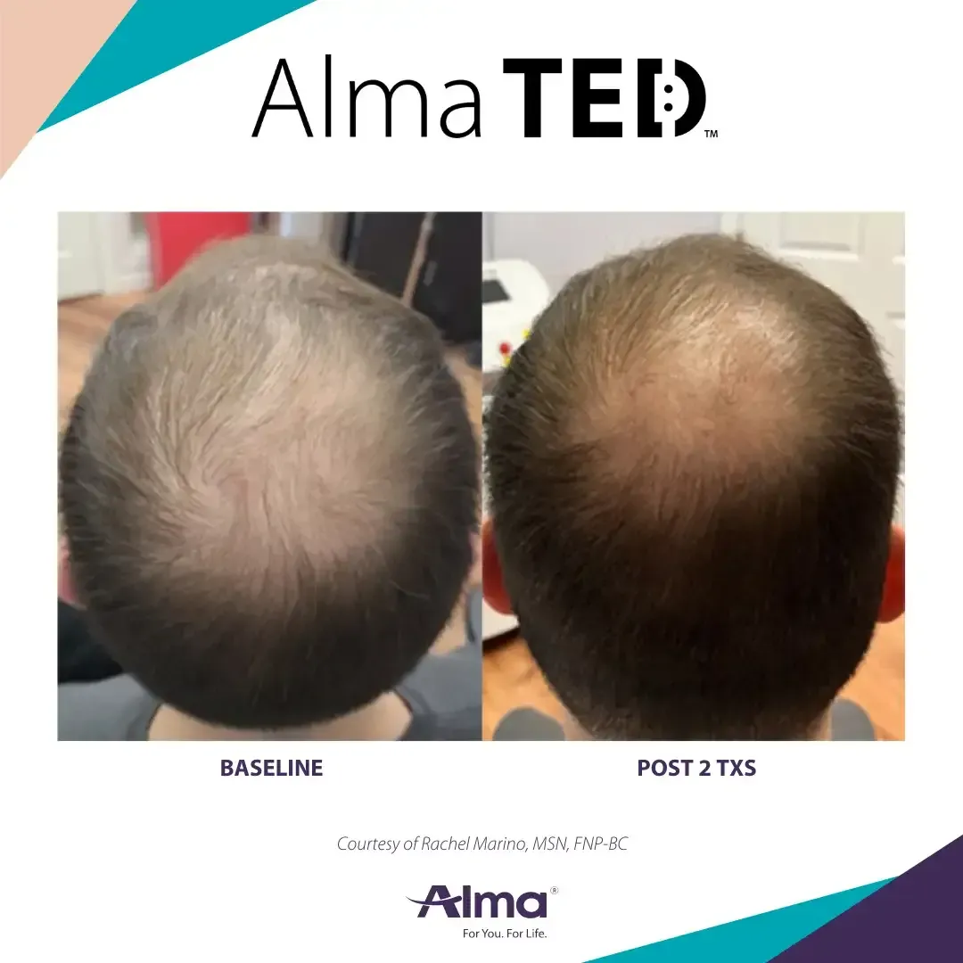 A picture of a man 's head before and after alma ted treatment