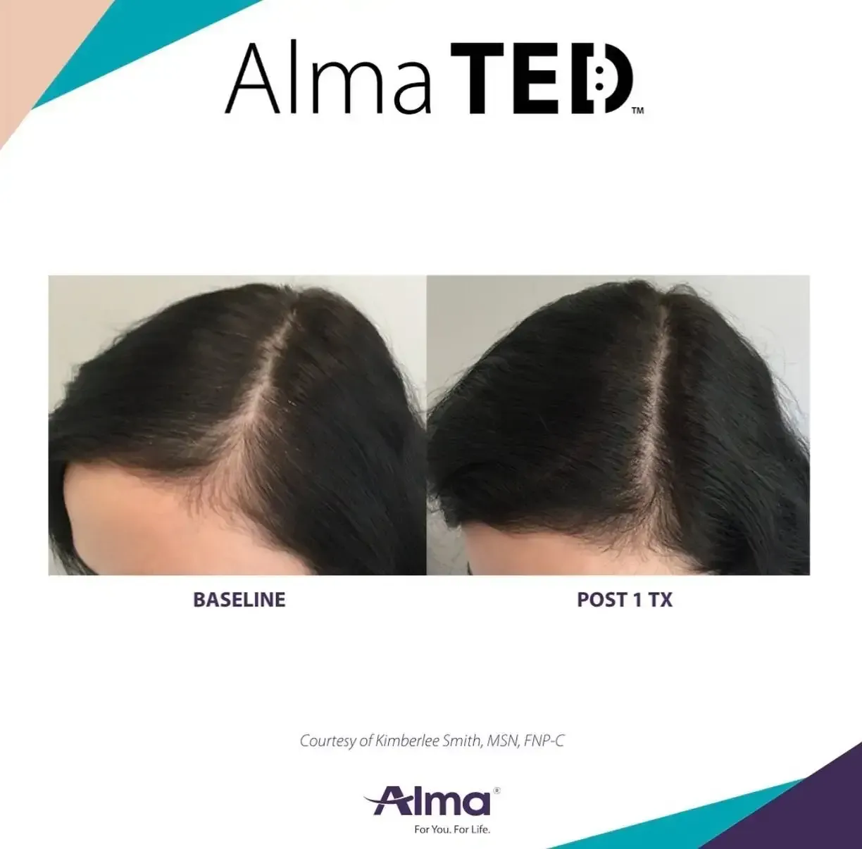 A woman 's hair is shown before and after alma ted treatment