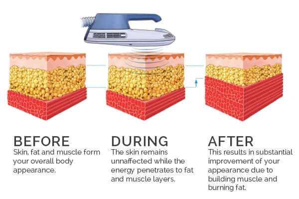 EMSCULPT NEO at Elite Diabetes & Endocrine Specialists in Boca Raton, Florida