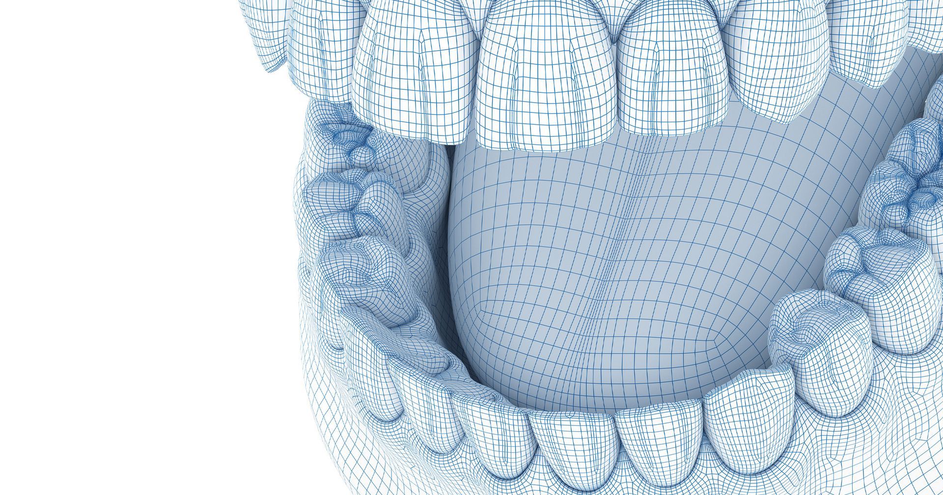 full mouth dental implants