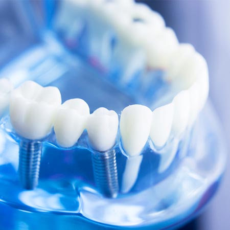Dental Implants