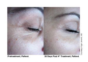 pelleve treatment before and after