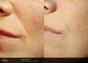 pelleve treatment before and after