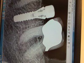 dental implant x-rays after