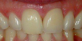 dental implants after