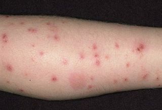 Rashes — Stockton, CA — Area Wide Exterminators