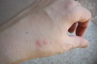 Symptom of Bed Bug — Stockton, CA — Area Wide Exterminators