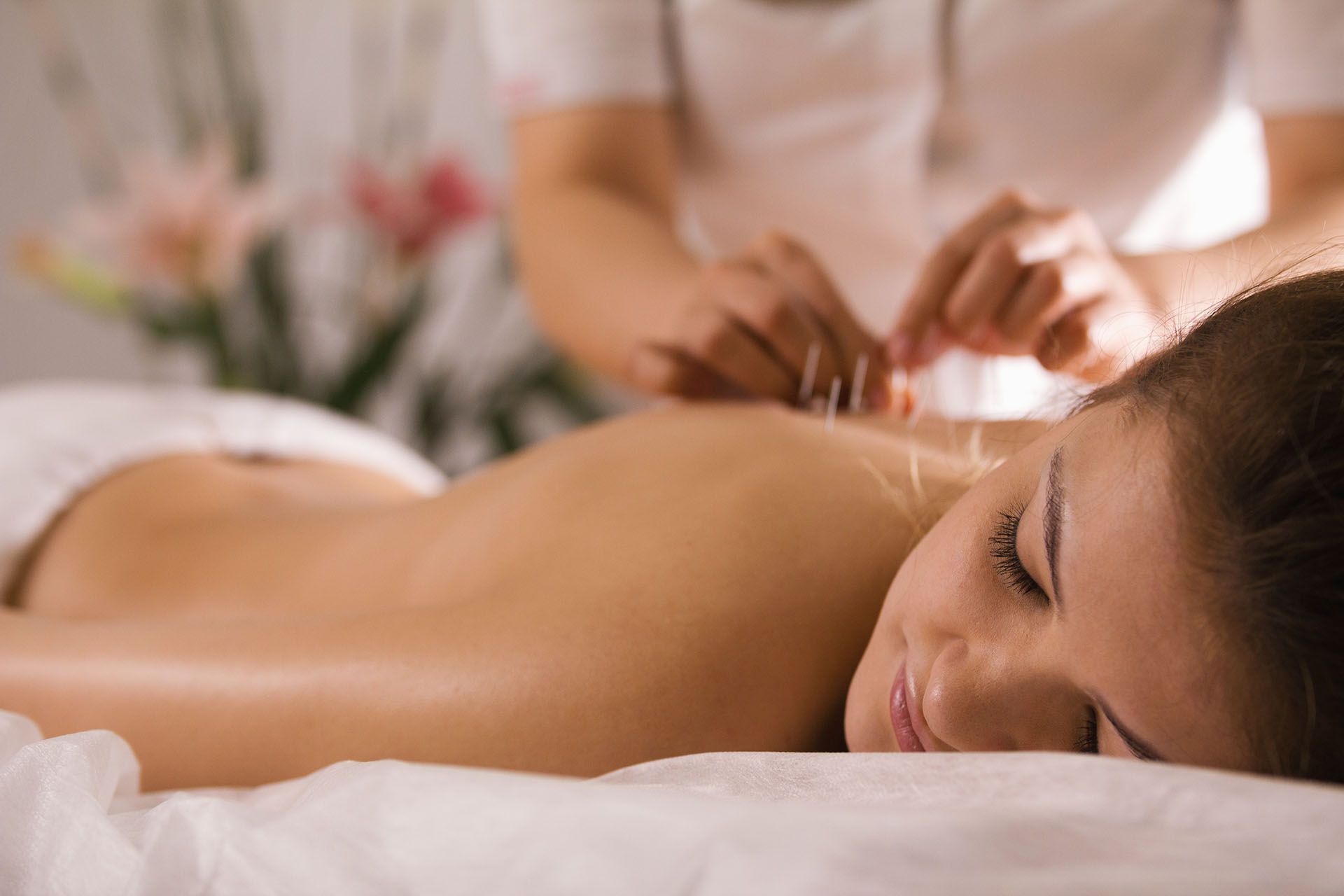 Close-up of a woman receiving an acupuncture treatment in her back.