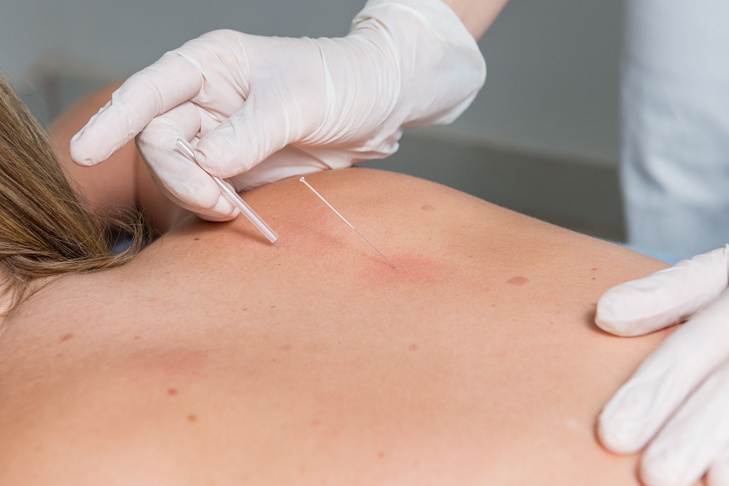 Gloved hands inserting an acupuncture needle into the upper back during treatment.