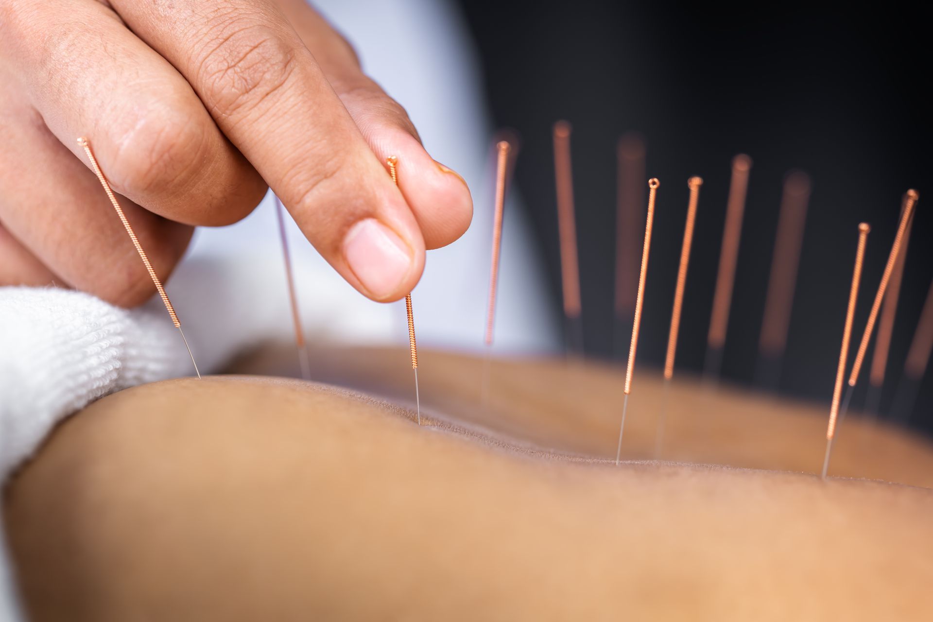 A person is getting acupuncture therapy.