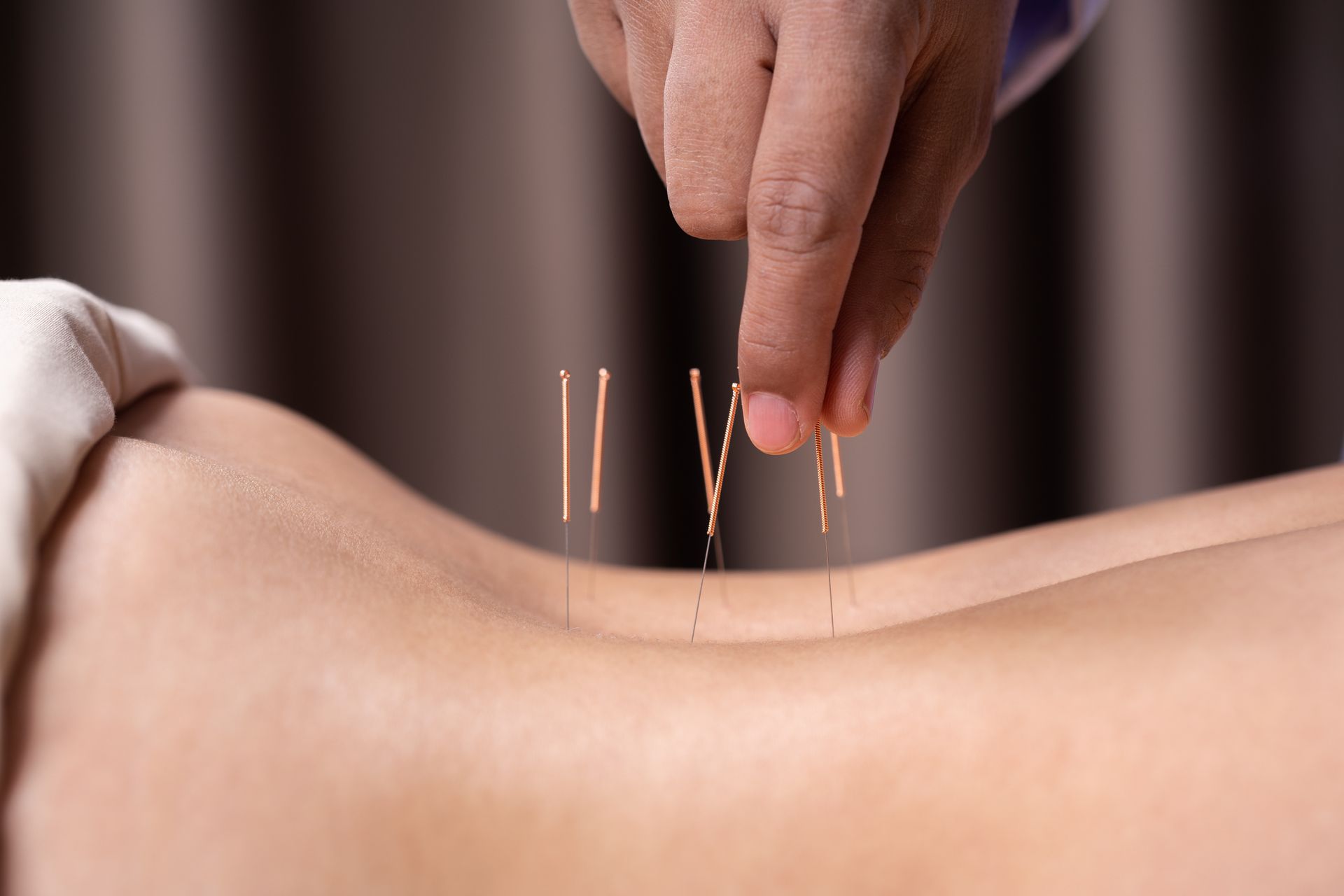 A woman is getting acupuncture treatment on her back.