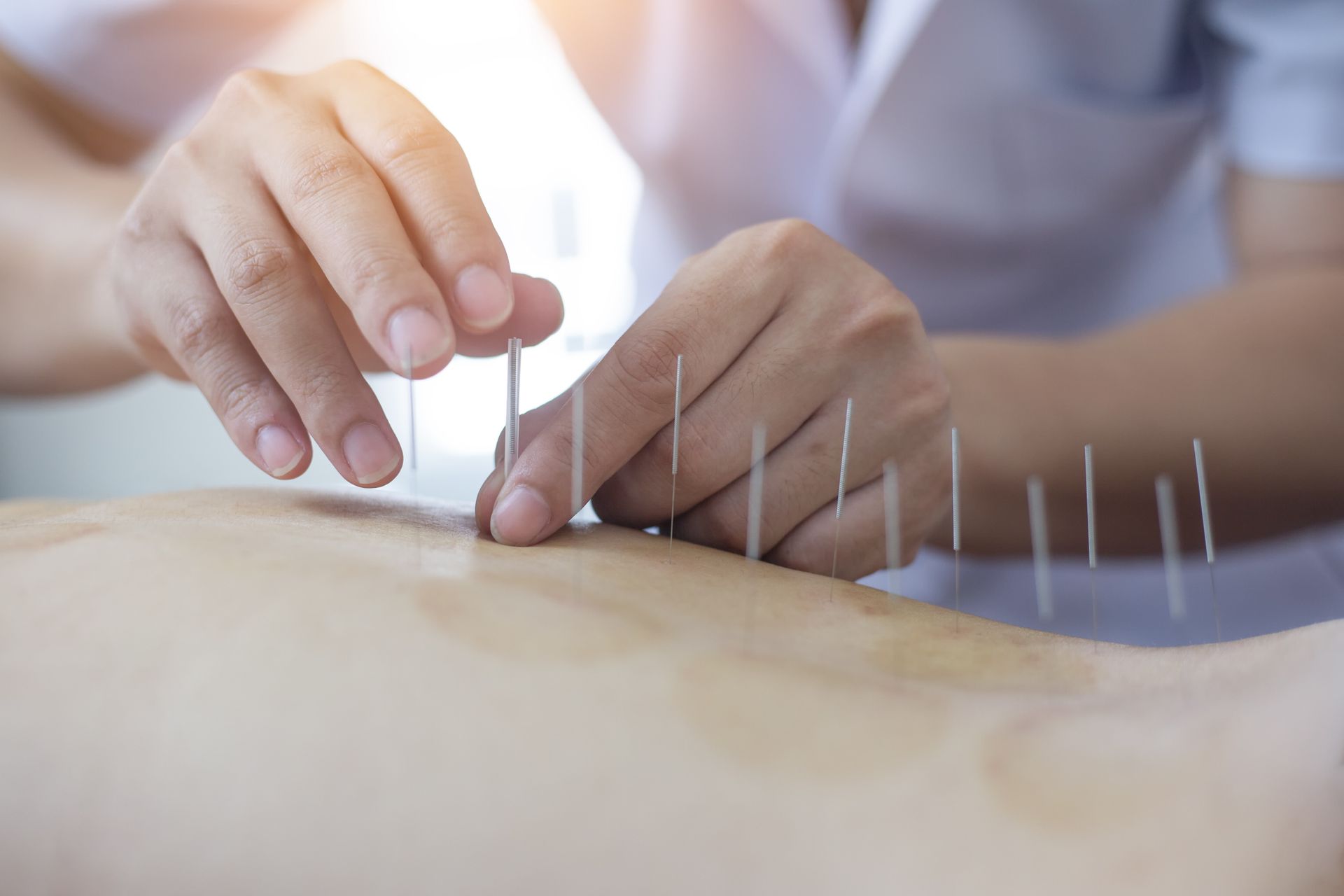 A person receiving acupuncture treatment | Holistic Medicine A person receiving acupuncture treatment | Holistic Medicine