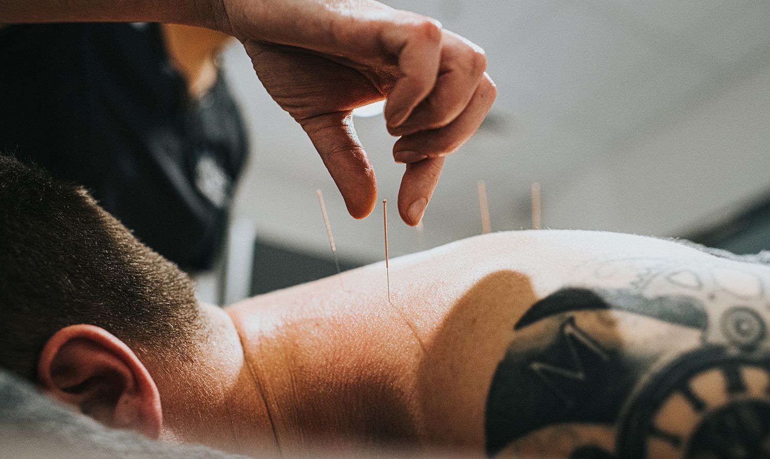 Close-up of acupuncture needles being inserted into a person’s upper back.
