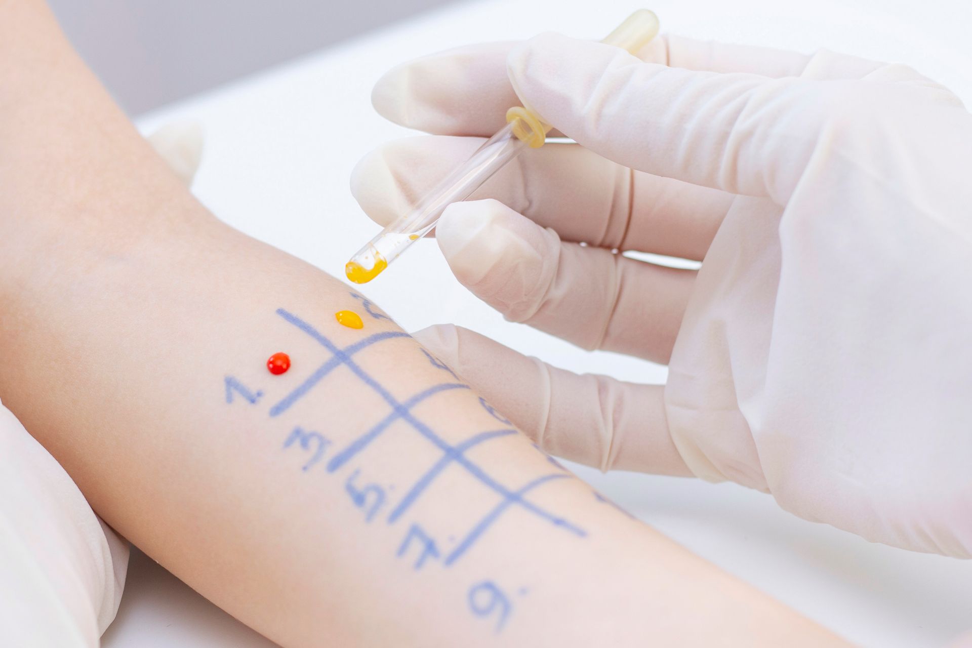 A hives specialist near me is doing a skin prick test to identify potential allergens