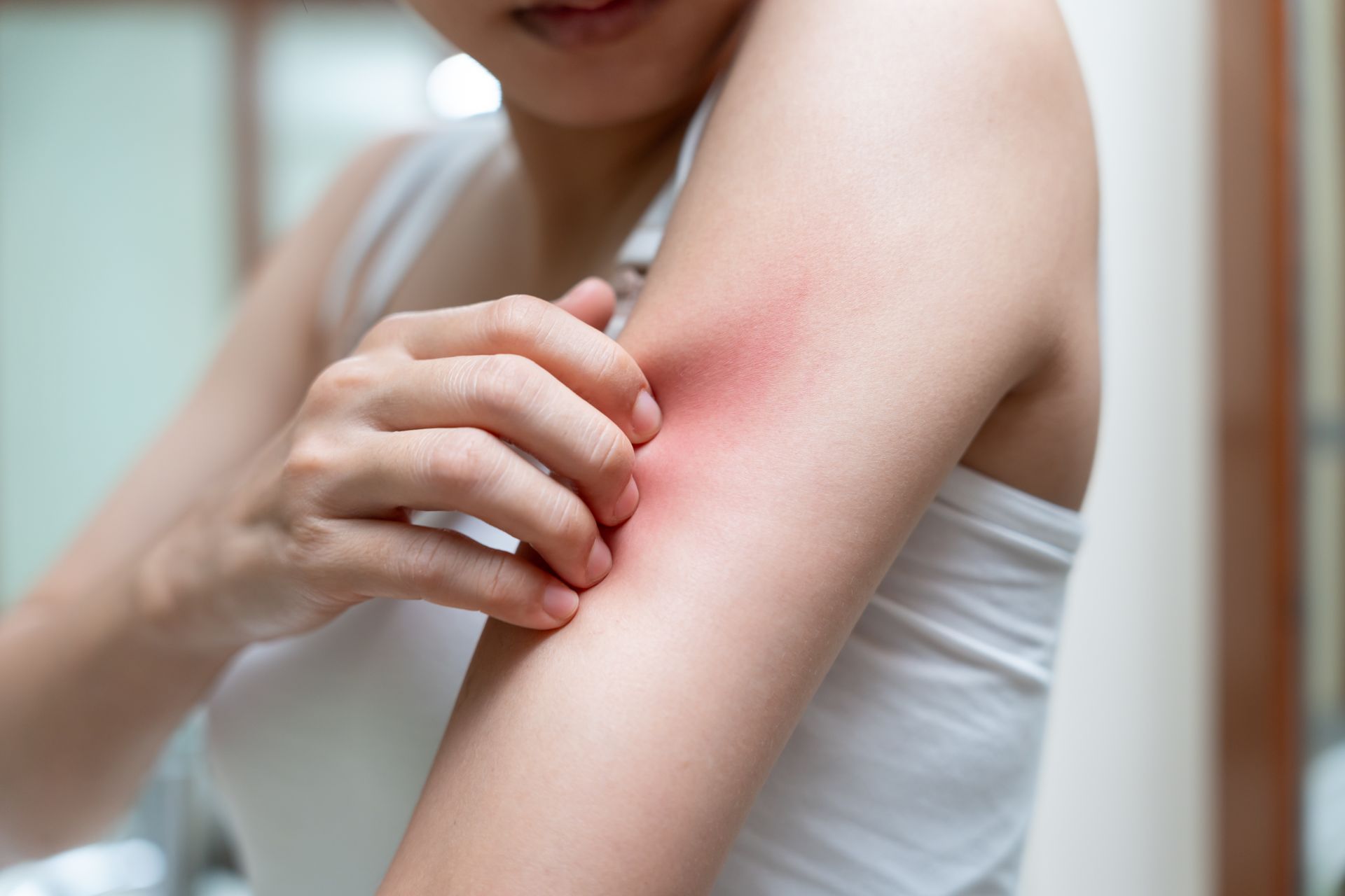  A woman suffering from chronic spontaneous urticaria (CSU) or chronic hives.