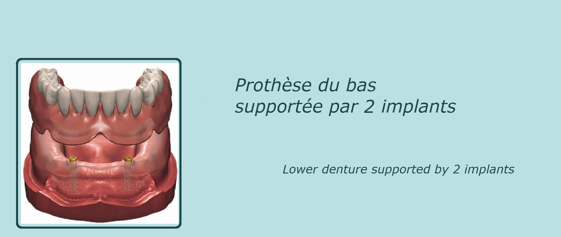 image représentant une prothèse dentaire du bas supportée par 2 implants