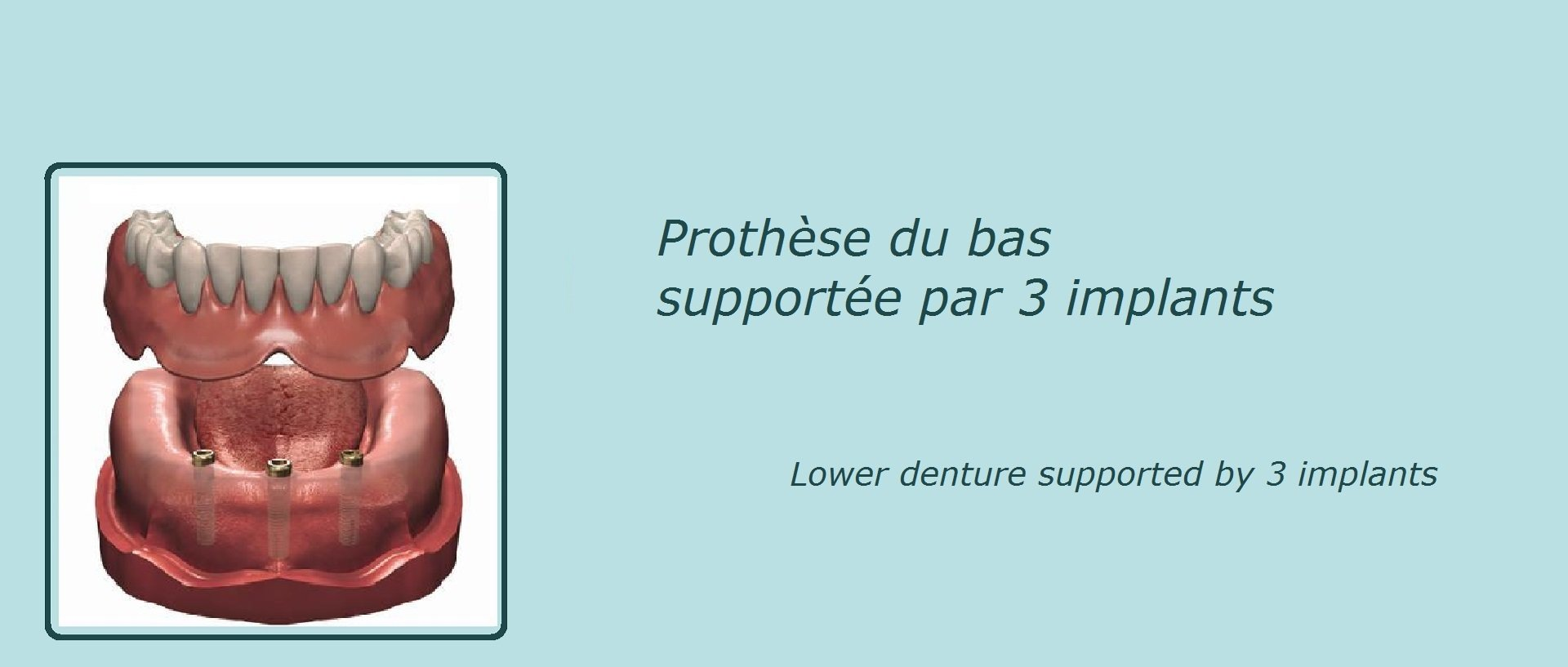 image représentant une prothèse dentaire du bas avec 3 implants