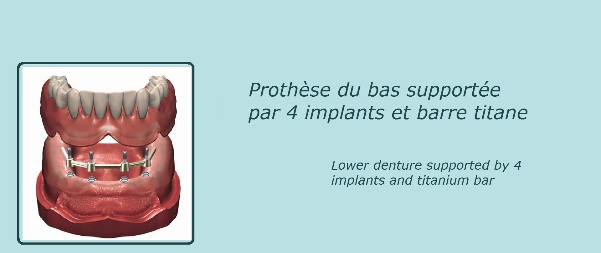 image représentant une prothèse dentaire du bas supportée par 4 implants et une barre de titane