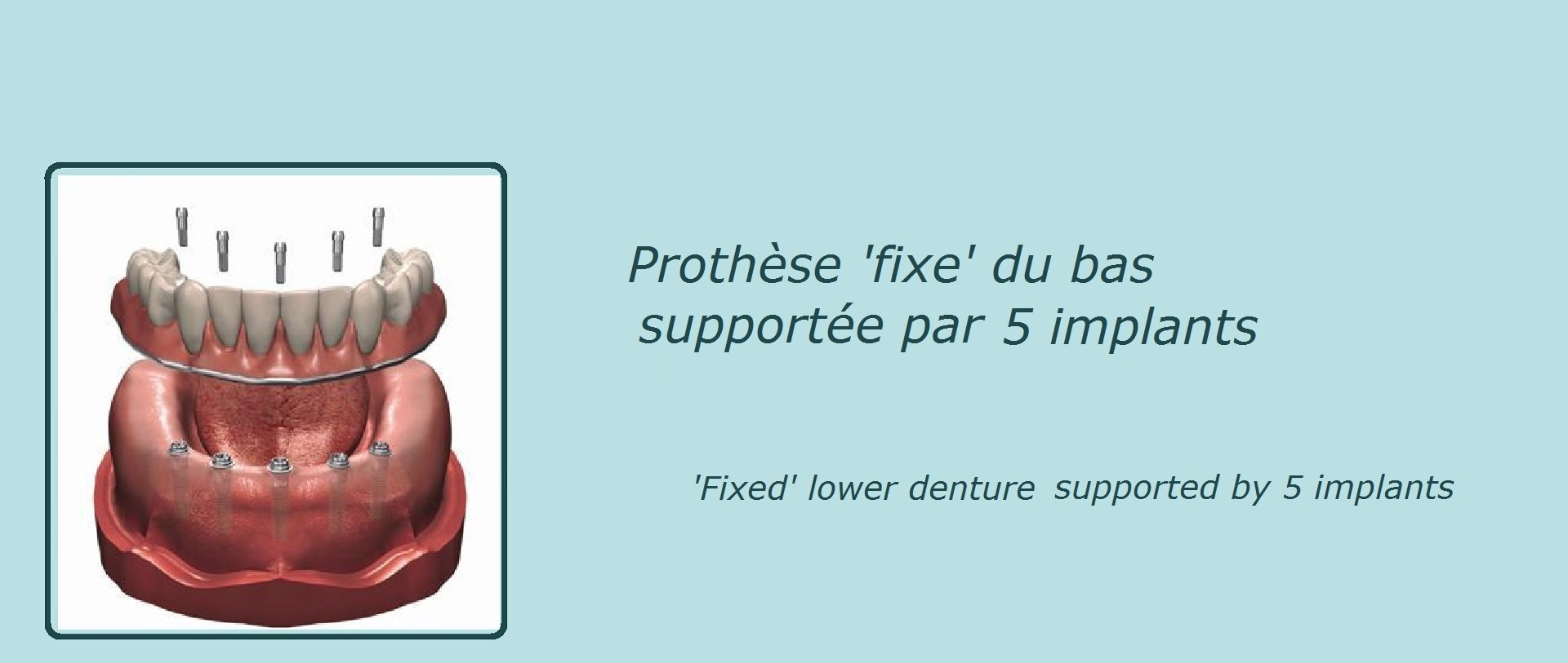 image représentant une prothèse dentaire fixe du bas sur 5 implants