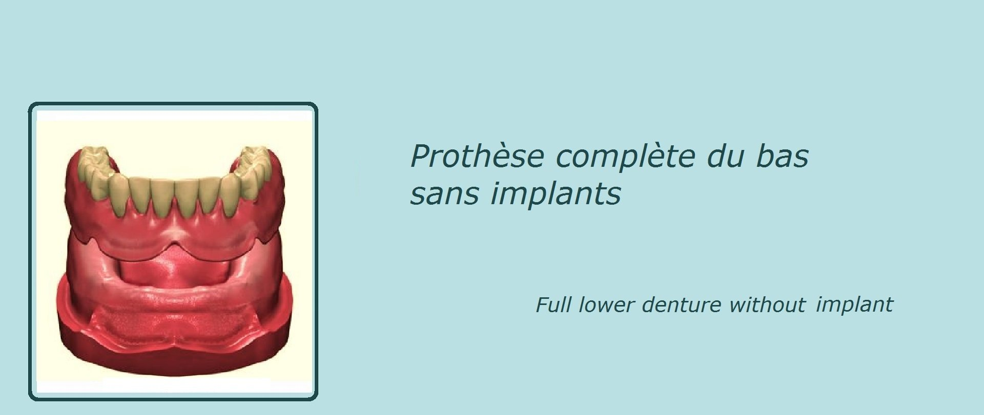 image représentant une prothèse dentaire complète du bas sans implant