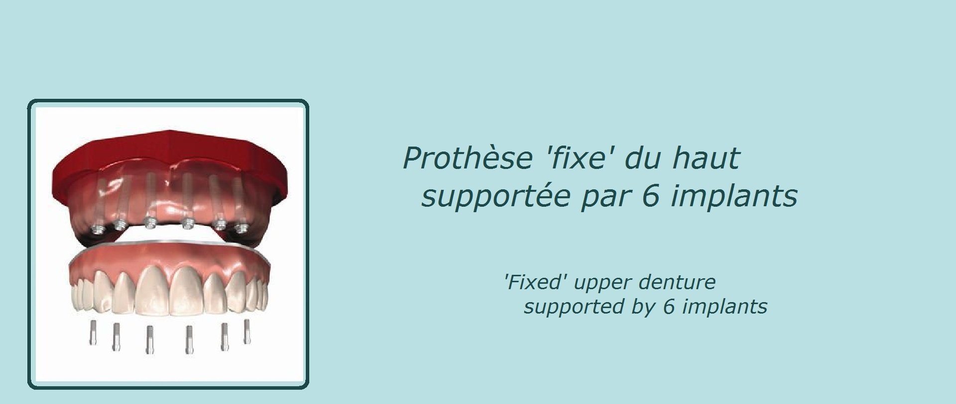 image représentant une prothèse dentaire fixe du haut supportée par 6 implants