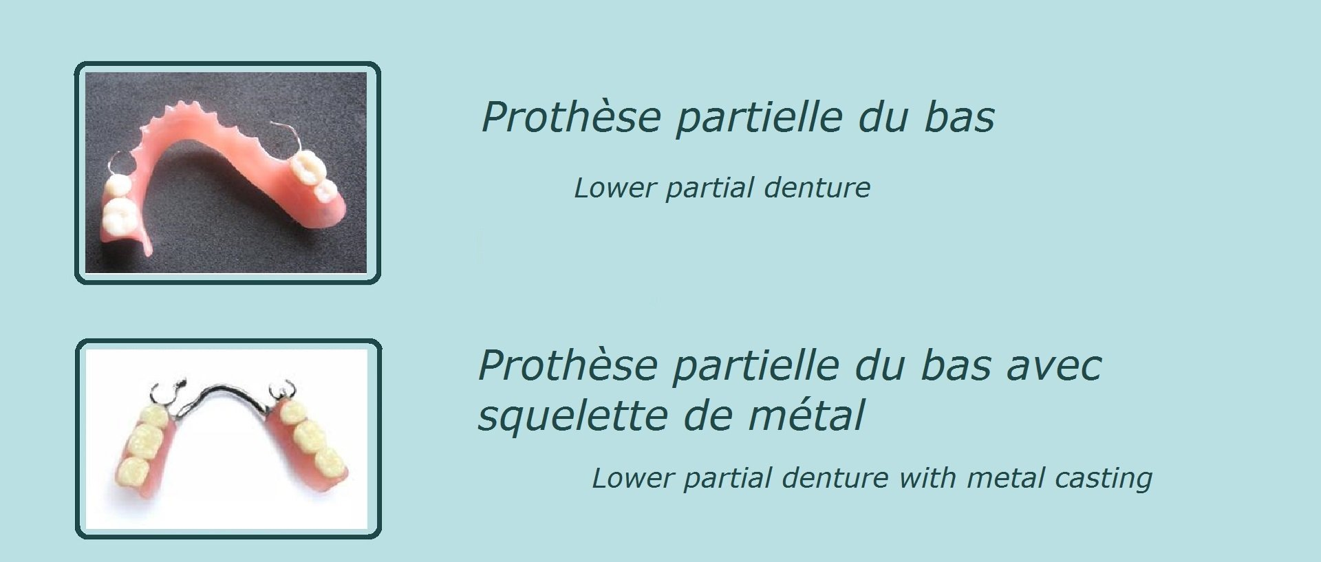 image représentant une prothèse dentaire partielle du bas